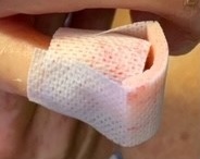 Digital Ulcers