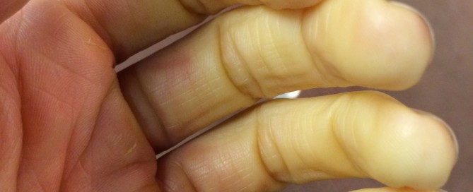 Acute Ischemia